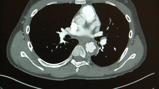 A post-operative CT scan shows the stent graft in the descending thoracic aorta with aortic remodeling.
