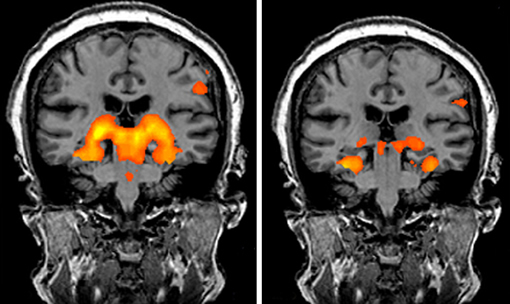 glutamate rel biomarkers in drug dev for