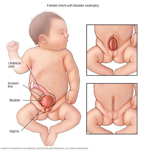 A medical illustration of a baby with the bladder on the outside of the body.