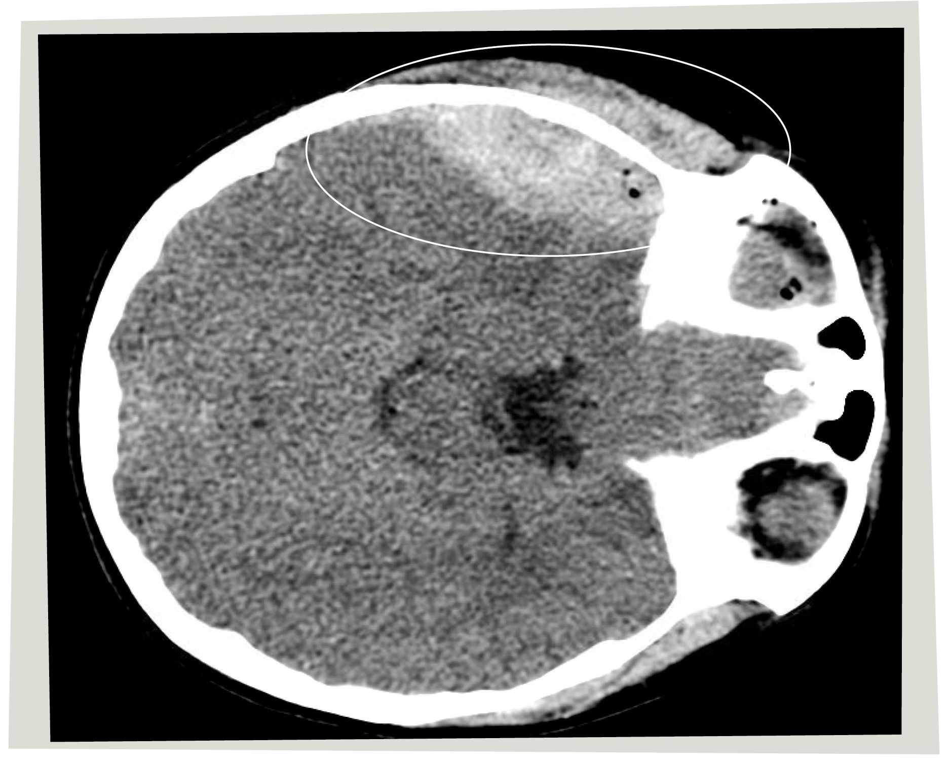 Brayden's CT scan showing an area of white where the acute traumatic epidural hematoma occurred.