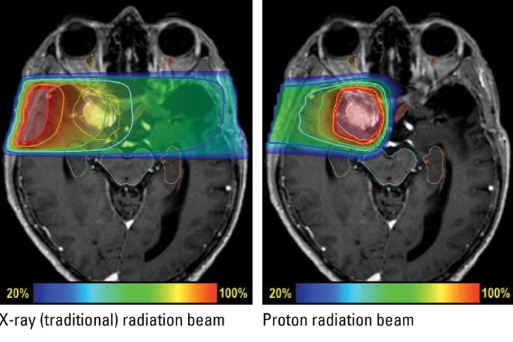 A magnetic resonance image of the brain shows how an X-ray beam delivers radiation both before a tumor and after it. A second image shows that a proton beam, by comparison,delivers less radiation on the way to the tumor and almost no radiation after it. 