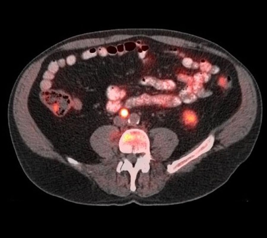 A medical image of a patient's prostate cancer, shown as glowing white, pink and red spots.