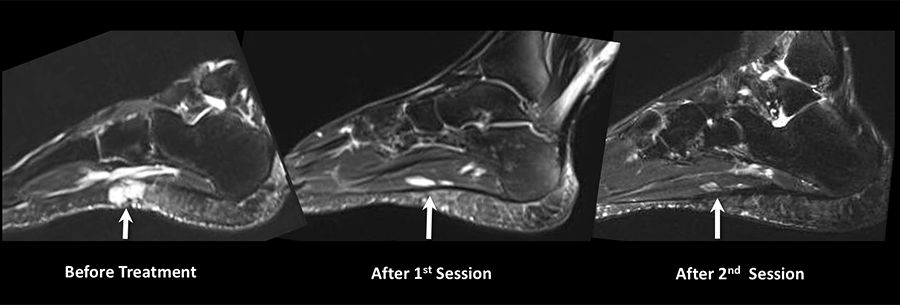 MRI of the patient's foot with a venous malformation disappearing as it is being treated.