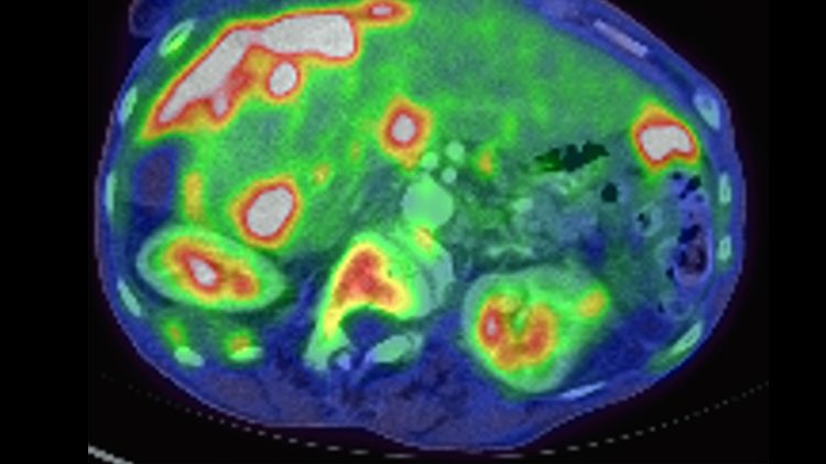 A medical image of an ovary with cancer, showing up as orange and red masses on a blue and green circular background.