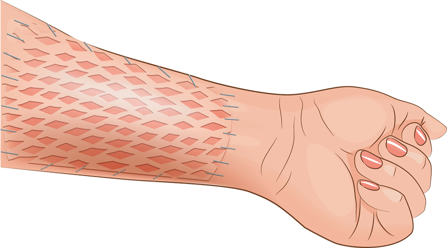 Medical illustration depicts a forearm with a transplanted skin graft.