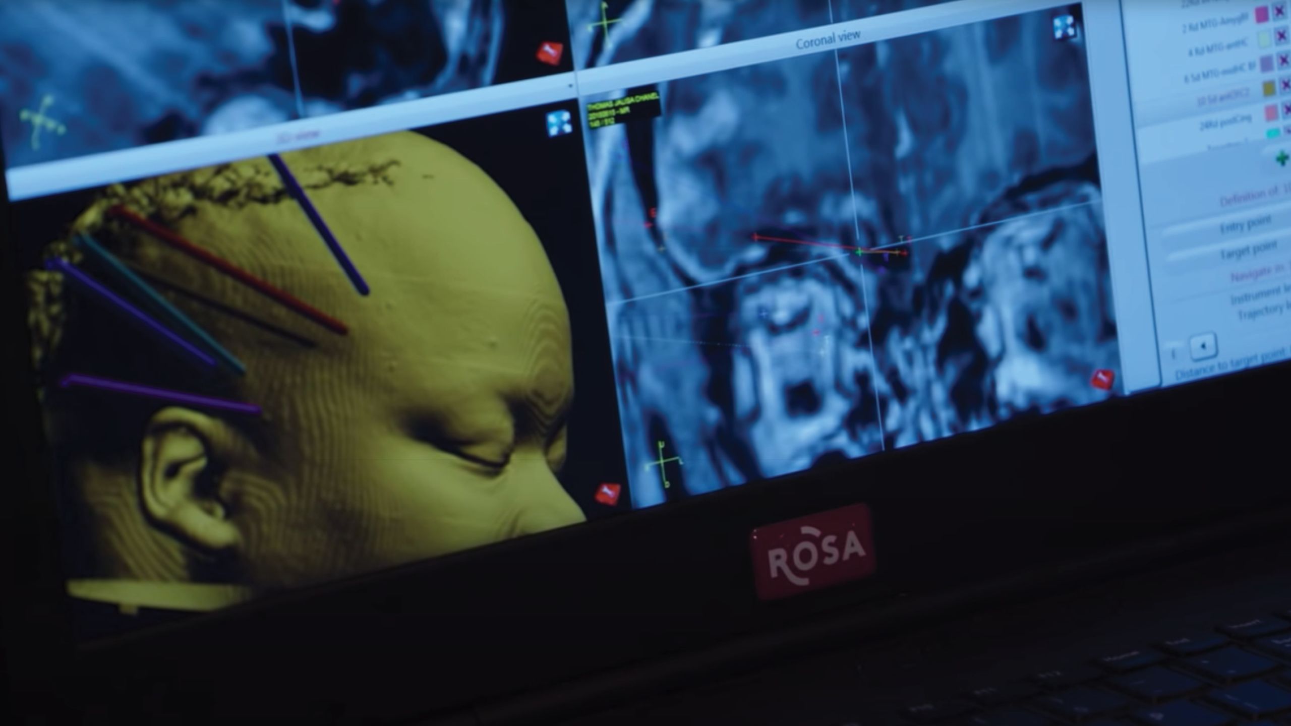 A patient is shown on a monitor under sedation with a scan of her brain.