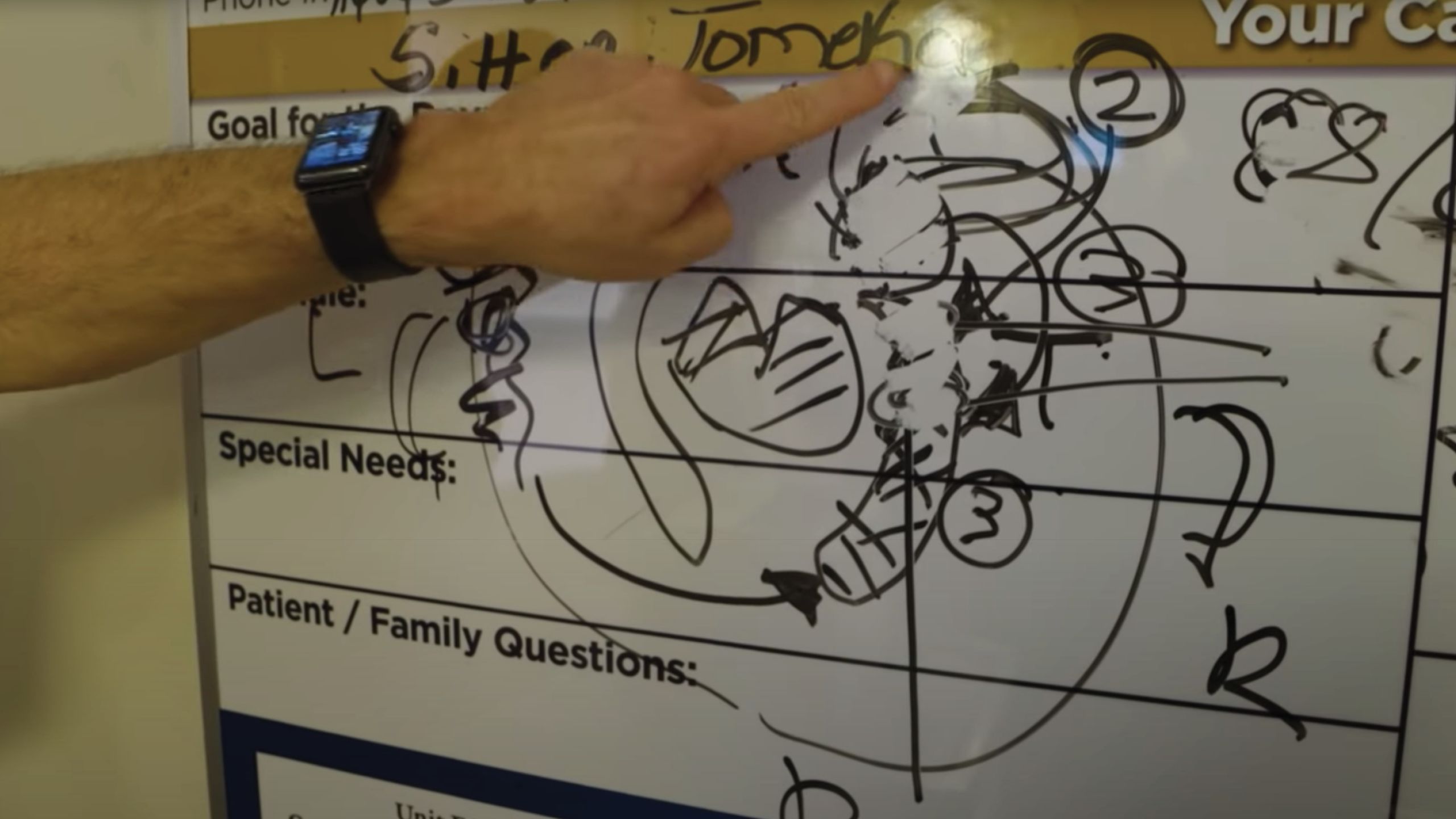 A white board with a drawing of a surgical plan for a brain scribbled on it in marker.