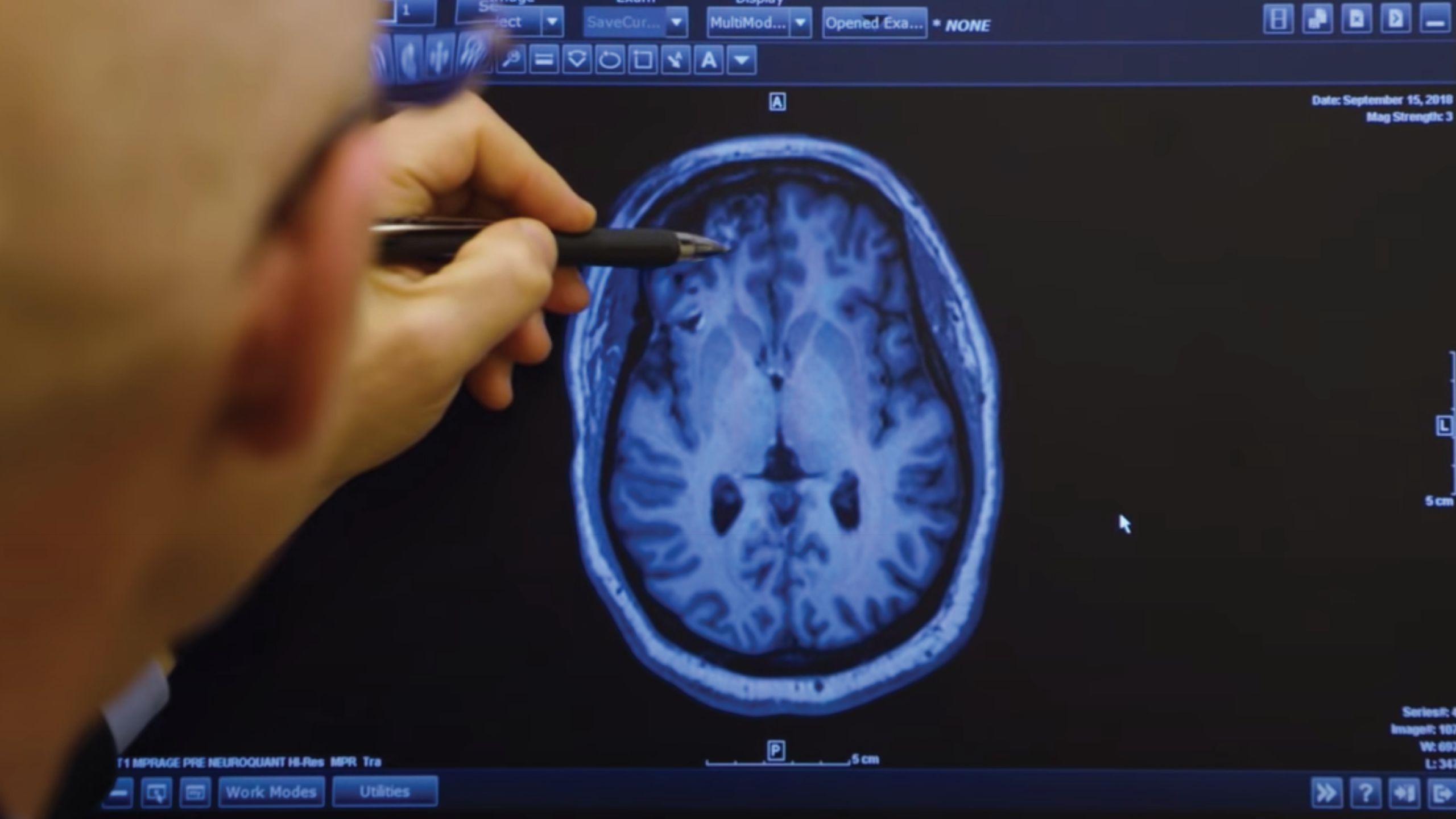 A doctor uses a pen to point out a specific area of a brain on a computer screen.