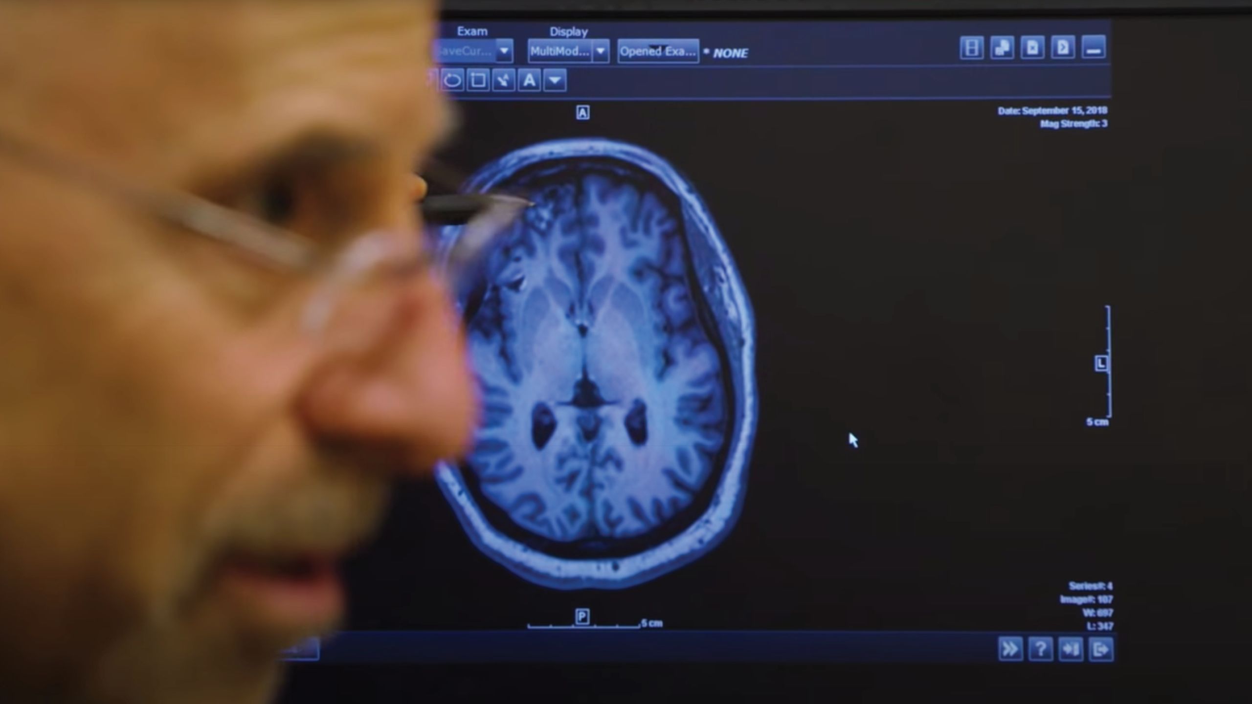 A doctor's profile over the image of a brain on a computer screen.
