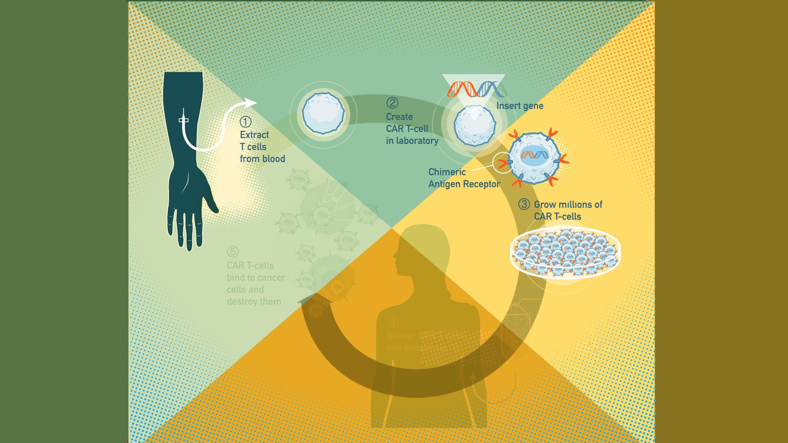 CAR T-cell therapy process infographic