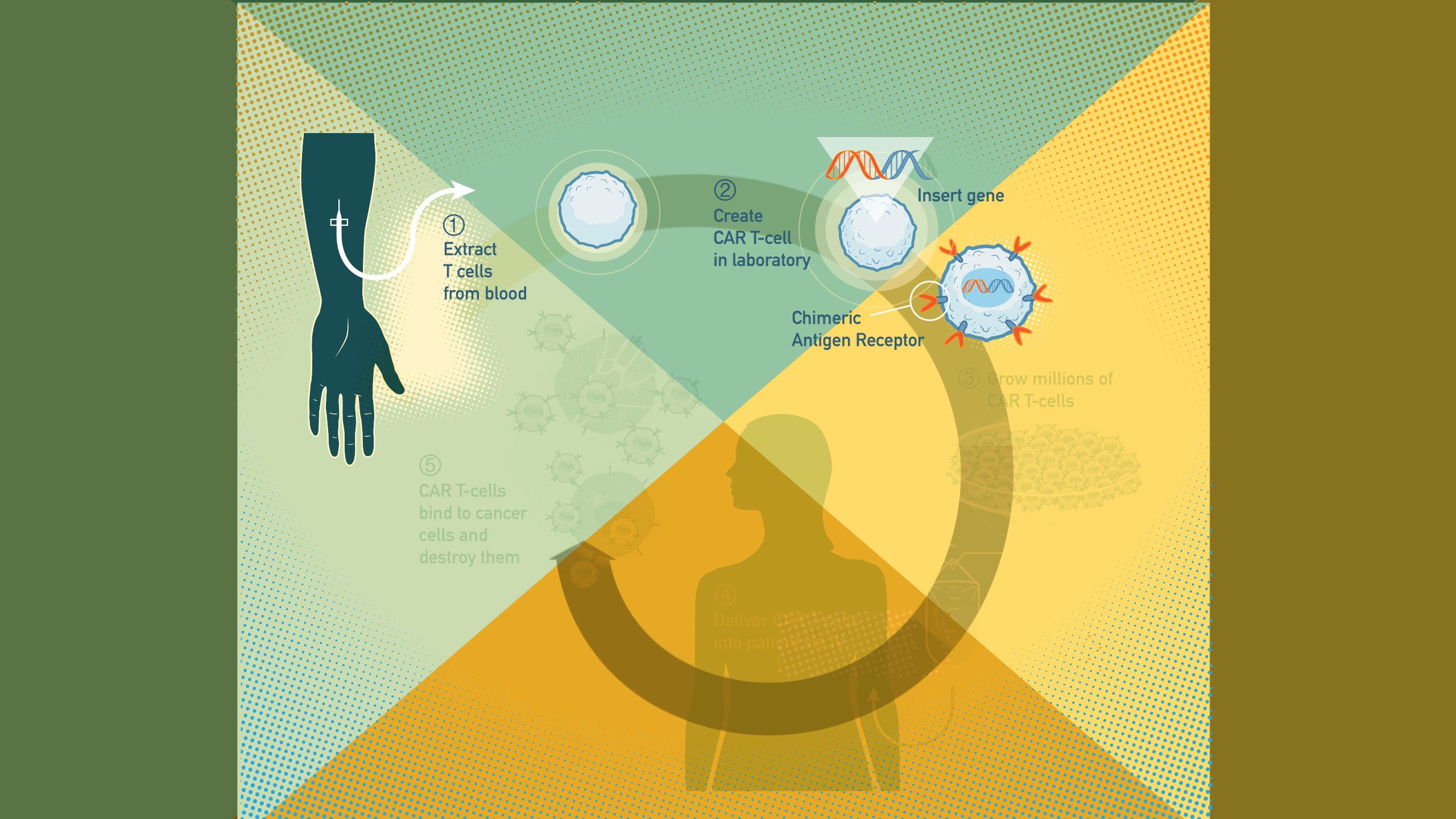 CAR T-cell therapy process infographic