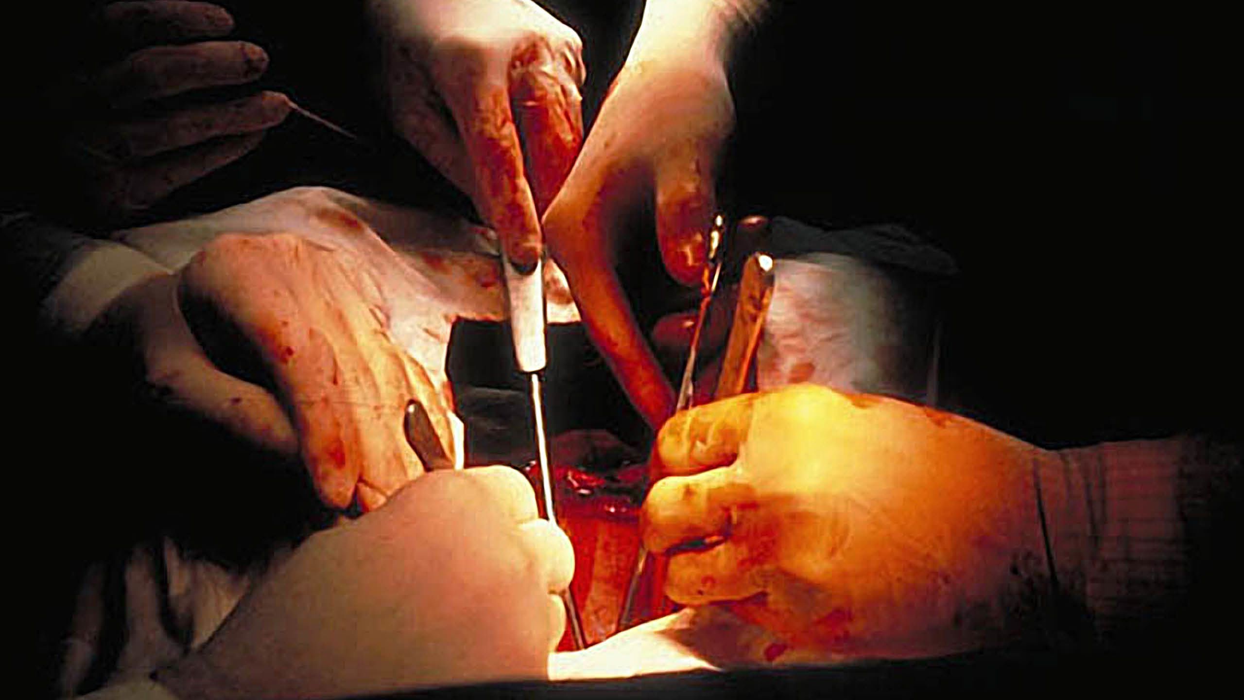 An up-close shot of a heart surgery. Emory’s heart transplant program began in 1985. In 2008, the hospital celebrated its 500th heart transplant. From 2008 to 2021, transplant surgeons completed an additional 500 transplants in just 13 years. Photo Billy Howard
