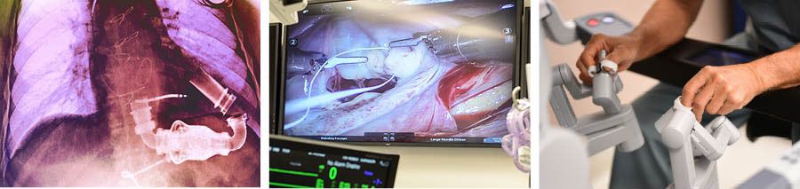 An LVAD implanted in the chest, tracking the blood circulating, and operating the robotic cardiac surgical device
