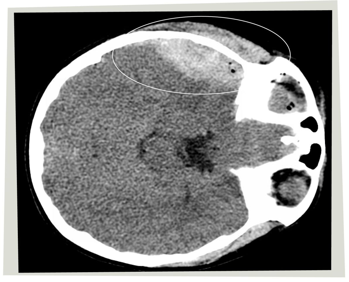 CT scan showing an area of white where the acute traumatic epidural hematoma occurred.