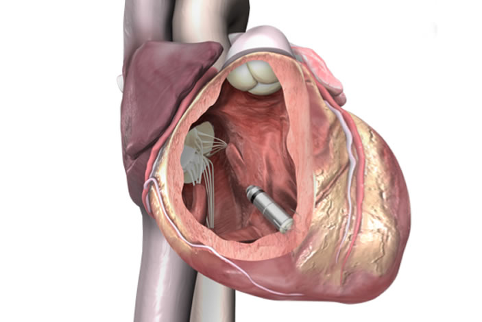 The pacemaker is delivered via a catheter through the femoral vein and positioned inside the right ventricle of the heart.