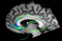 Brain scan deep brain stimulation
