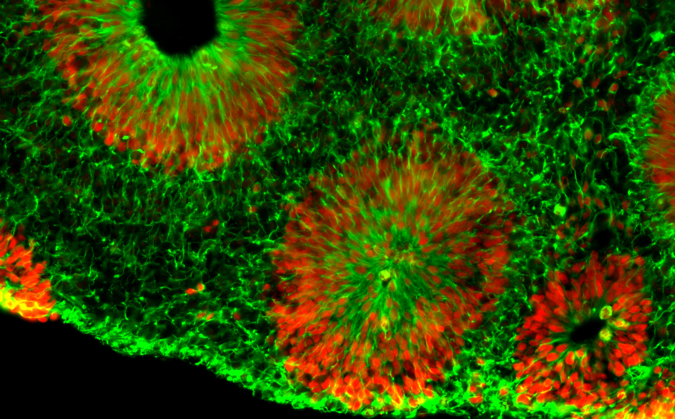 Microscope images of fragile X human brain organoids, courtesy of Zhexing Wen. Green represents cytoplasmic Nestin while red represents nuclear Sox2; both are markers for neural progenitor cells. 