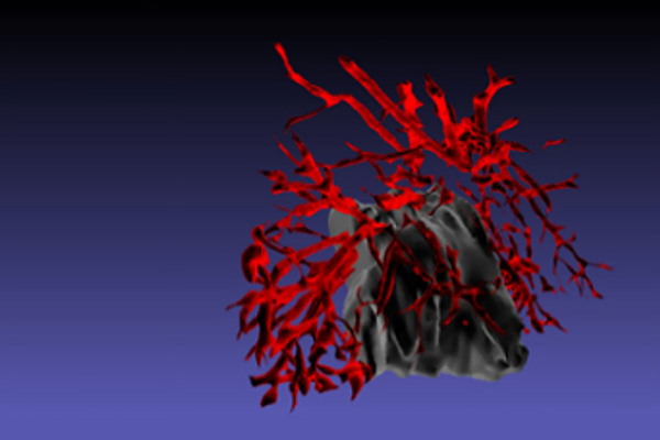 3D rendering of a tumor and the corresponding vasculature.