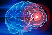 ENRICH study leads to first positive surgical trial in the deadliest type of stroke
