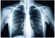 AI model enables earlier detection of diabetes through chest x-rays