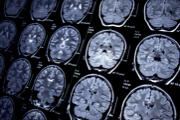 Emory researchers discover promising treatment for epileptic seizures