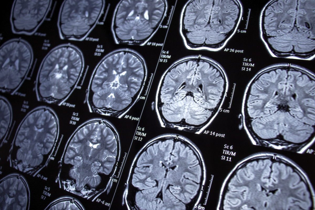 Emory researchers discover promising treatment for epileptic seizures