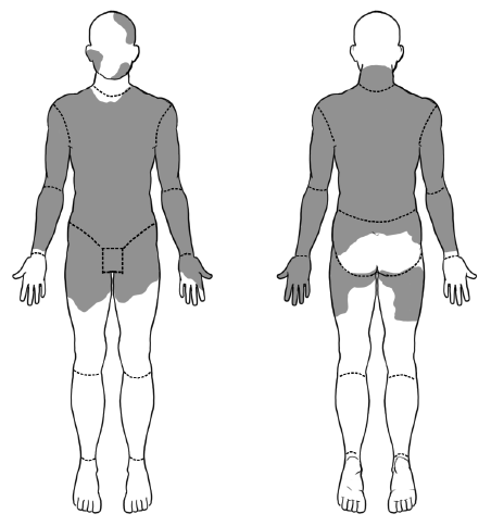 Two outlines of a man's body — front and back — are shaded to illustrate where burns damaged Richardson's skin. Doctors determined that he had third-degree burns across 60 to 70 percent of his body, including his chest and torso, his back, both arms, and patches across his upper thighs and face.